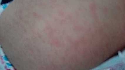 宝宝长疹子是什么原因引起的,宝宝长疹子怎么好得快