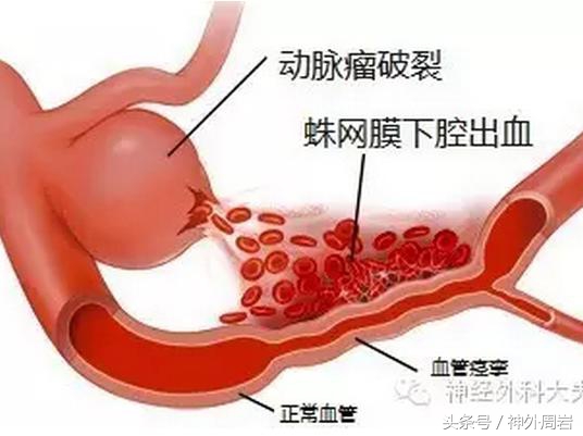 妊娠反应头疼怎么回事,妊娠高血压产后头痛严重吗