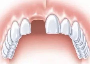 多颗牙缺失做烤瓷牙还是种植牙好,牙齿缺失是种植牙好还是烤瓷牙好