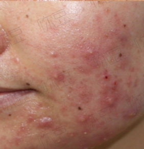 班赛祛痘吗,用班赛会爆痘吗