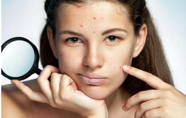 红色痘印怎么快速消除不留疤痕,怎么快速消除痘印痘坑美白