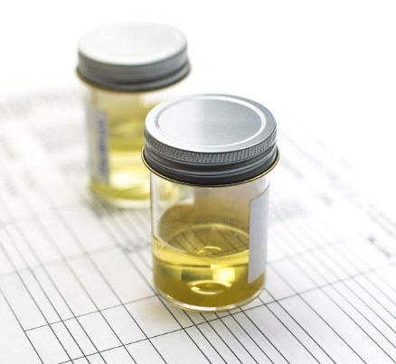 尿蛋白2+需要激素治疗吗,iga肾病吃激素多久尿蛋白降