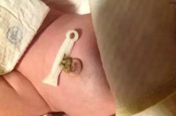 新生儿肚脐5个异常要注意！这篇宝宝脐部护理攻略送给月嫂！