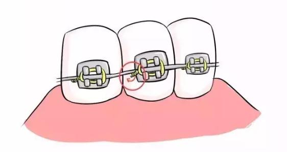 戴牙套扎嘴怎么办,牙套铁丝末端扎嘴怎么办