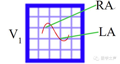左心房肥大和右心房肥大心电图,心电图左室肥大右室肥大