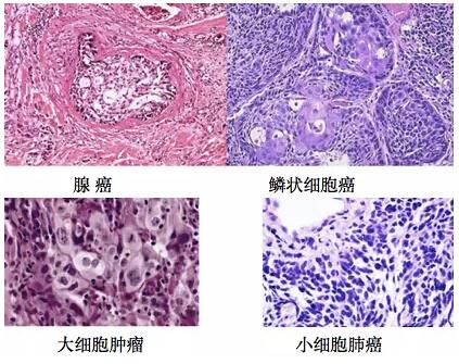 ki6710%是良性肿瘤还是恶性肿瘤,良性肿瘤和恶性肿瘤区别有哪些