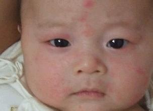 小孩皮肤过敏怎么办教你一招解决,小孩皮肤过敏怎么办最快方法