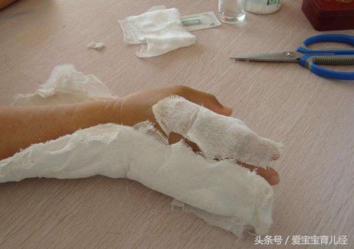 妈妈一时疏忽大意,导致4岁男童3根手指“骨折”!