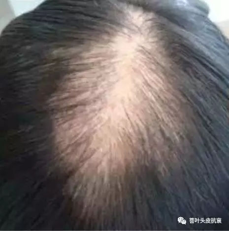 脱发案例丨菩叶毛囊赋活30天,生发效果立竿见影!