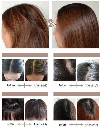脱发案例丨菩叶毛囊赋活30天,生发效果立竿见影!