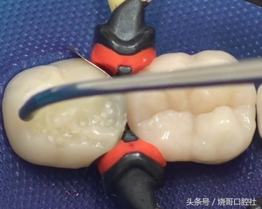 补牙一年多了咬东西还疼,补牙一年了咬合有点酸