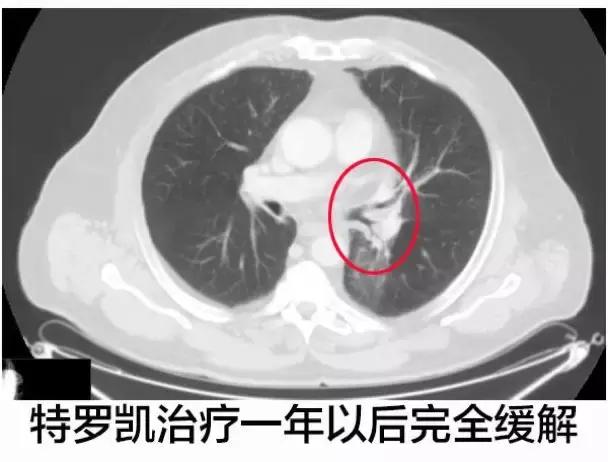 化疗失败后靶向药有效的案例,肺腺癌egfr突变耐药化疗