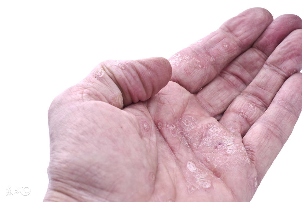 每日涂6次银屑病软膏,每日服用激素治银屑病的最佳时间