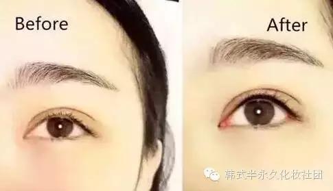 纹美瞳线七天脱痂过程图,纹美瞳线掉痂后反色过程图