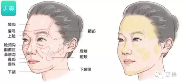 自体脂肪填充面部术后能坚持多久,自体脂肪填充面部术后1-3天变化图