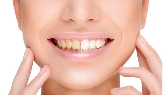 牙齿很黄如何美白牙齿,牙齿偏黄怎么办怎么美白