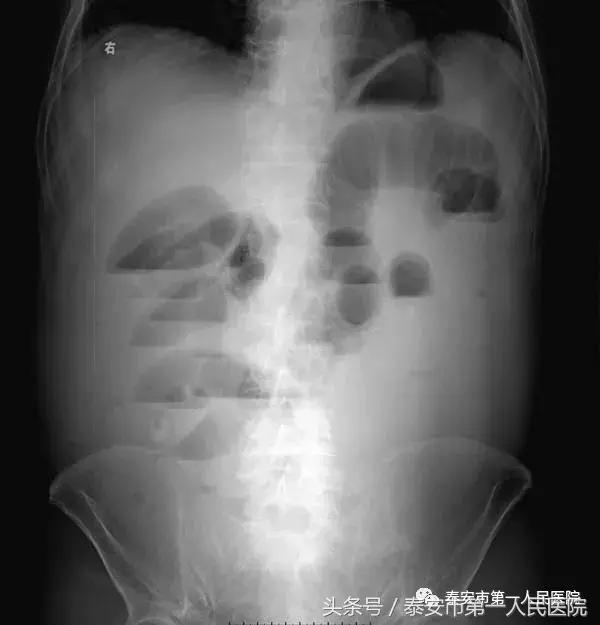 全国治疗重症胰腺炎最权威的医院,重症胰腺炎手术后多长时间能出院