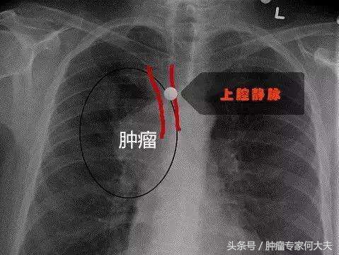 上腔静脉综合征是癌症吗,肿瘤造成上腔静脉梗阻怎么缓解