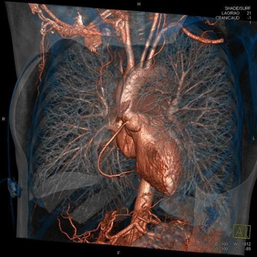 血管破裂几分钟死亡,突发血管破裂
