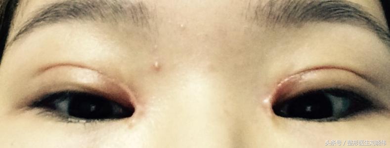开眼角留下的疤痕很明显能修复么,开眼角留下的疤痕用啥疤痕膏