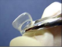 前牙光固化美容修复的方法,乳前牙预成冠修复过程