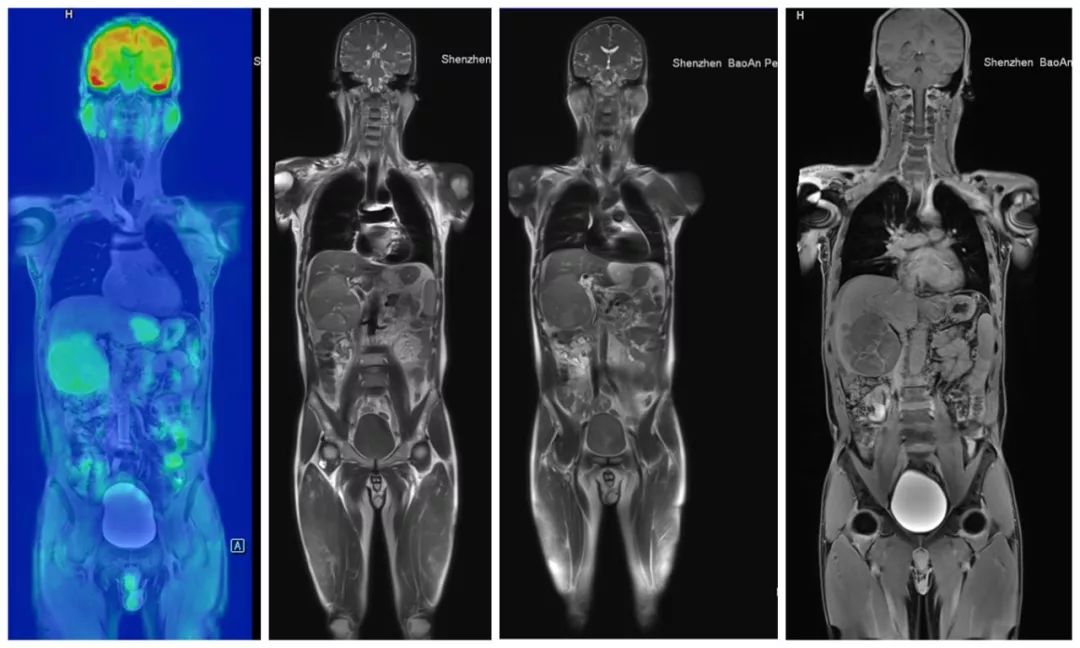 目前最先进的磁共振是啥,深圳扫描速度最快的核磁共振