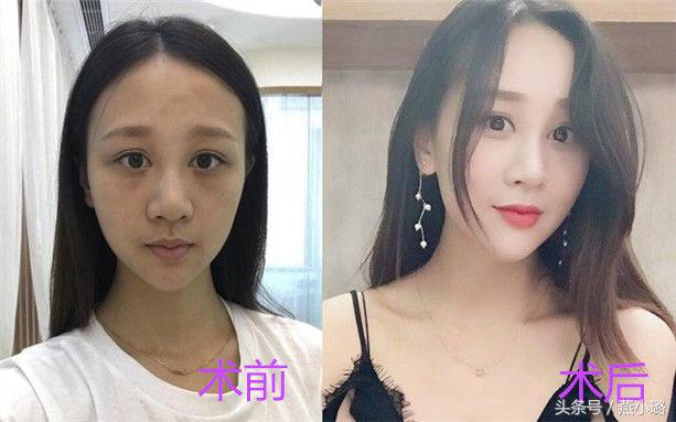 鑷綋鑴傝偑闈㈤儴濉厖鏈悗鎶ょ悊,鑷綋鑴傝偑濉厖鑴搁儴鏀惰垂鏍囧噯