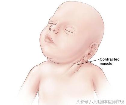 哈尔滨小儿推拿斜颈哪个地方好,小儿斜颈推拿的治愈率有多高