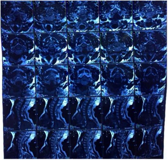 颈椎病压迫臂丛神经有哪些症状,颈椎病压迫神经引起面瘫怎么治疗