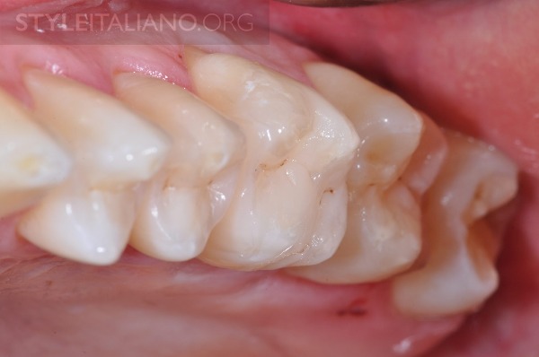 后牙修补贴片,后牙全瓷修复图片