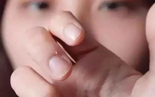 手指甲附近有倒刺是缺啥,孩子手指甲有竖纹是缺啥维生素