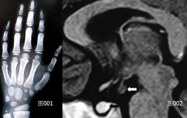 2岁女孩来月经怎么回事,12岁女童来例假前兆