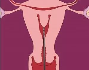 妈妈怀孕时“偷了一下懒”，从此你的子宫多了一坨肉