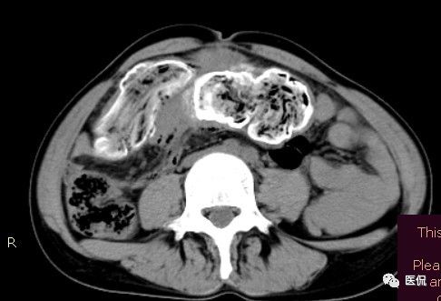 手术纱布遗留在体内可以吸收吗,手术纱布忘了取出会怎样