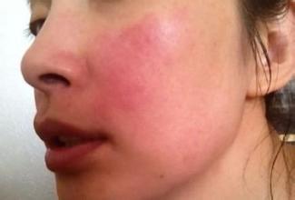 敷面膜过敏脸上满脸疙瘩怎么消除,别再乱敷面膜了敷对时机很重要