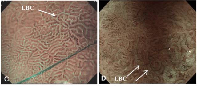 内镜检查痛苦吗,内镜检查是怎么做的