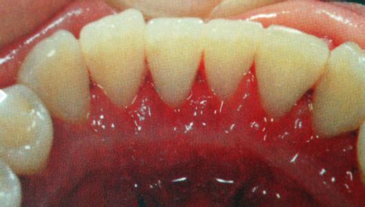 爱优牙牙齿矫正攻略,美牙中牙黄用什么处理牙齿会变白