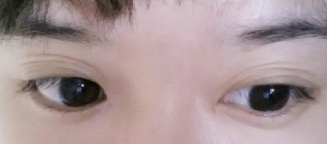 内双割双眼皮变成三眼皮怎么修复,双眼皮修复三次会有什么后果