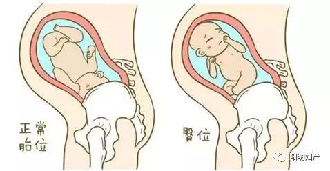 预产期要到了宝宝jio朝外？产科这套“乾坤大挪移”帮宝宝转身！