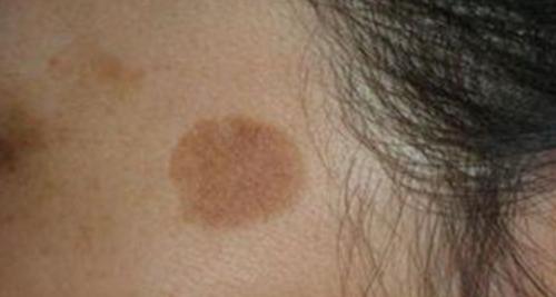 云南白药，黑人等牙膏去老年斑真的靠谱吗？哪种老年斑最危险？