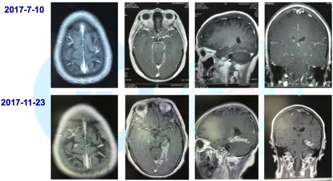 龙哥查房完整视频,肺腺癌治疗重大突破