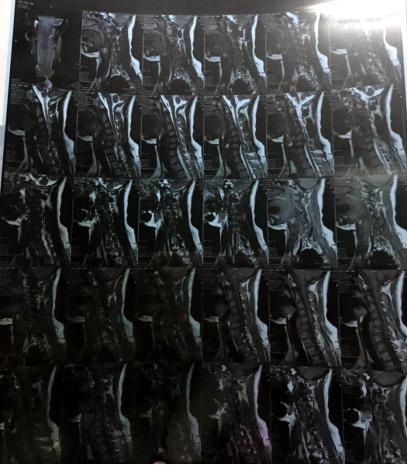 胳膊无力是什么类型的颈椎病,病人胳膊麻木没知觉怎么弄