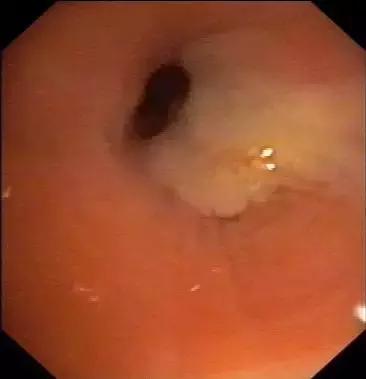 慢性支气管炎会导致咽喉有异物吗,反复咳嗽气管有痰不好怎么办