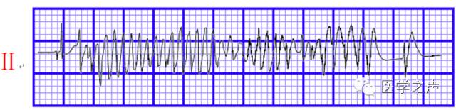 心电图速成视频讲座3,心电图的完整讲座视频