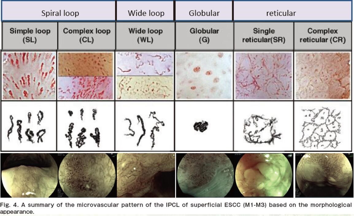早期食管癌用内镜可以根除吗,超声内镜可以查出早期食管癌吗