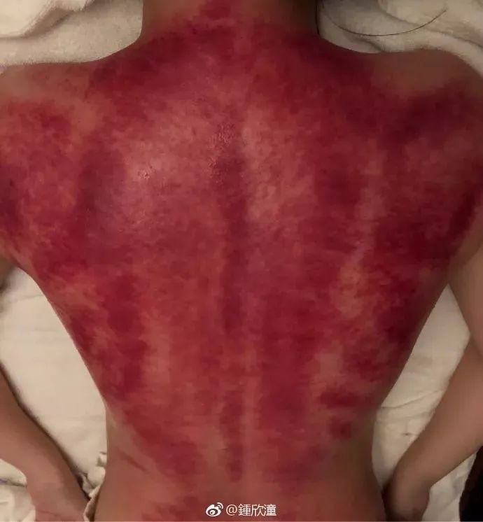 阿娇刮痧,阿娇刮痧养生视频