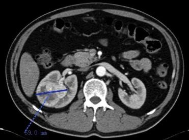 培唑帕尼和阿昔替尼哪个治肾癌好,阿昔替尼能治疗肾癌转移肝肺吗