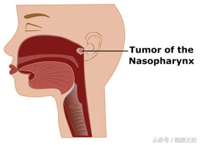 鼻咽癌怎样防止愈后复发,鼻咽癌患者复发和转移的高峰期