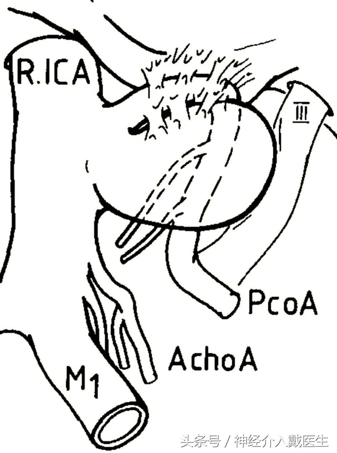 颅内高频声,听到颅内有咯噔声是什么原因
