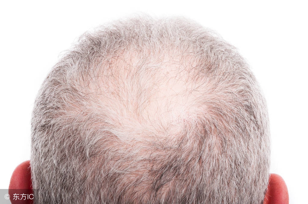 头皮屑多是什么原因呢,头皮屑多是什么原因怎么解决